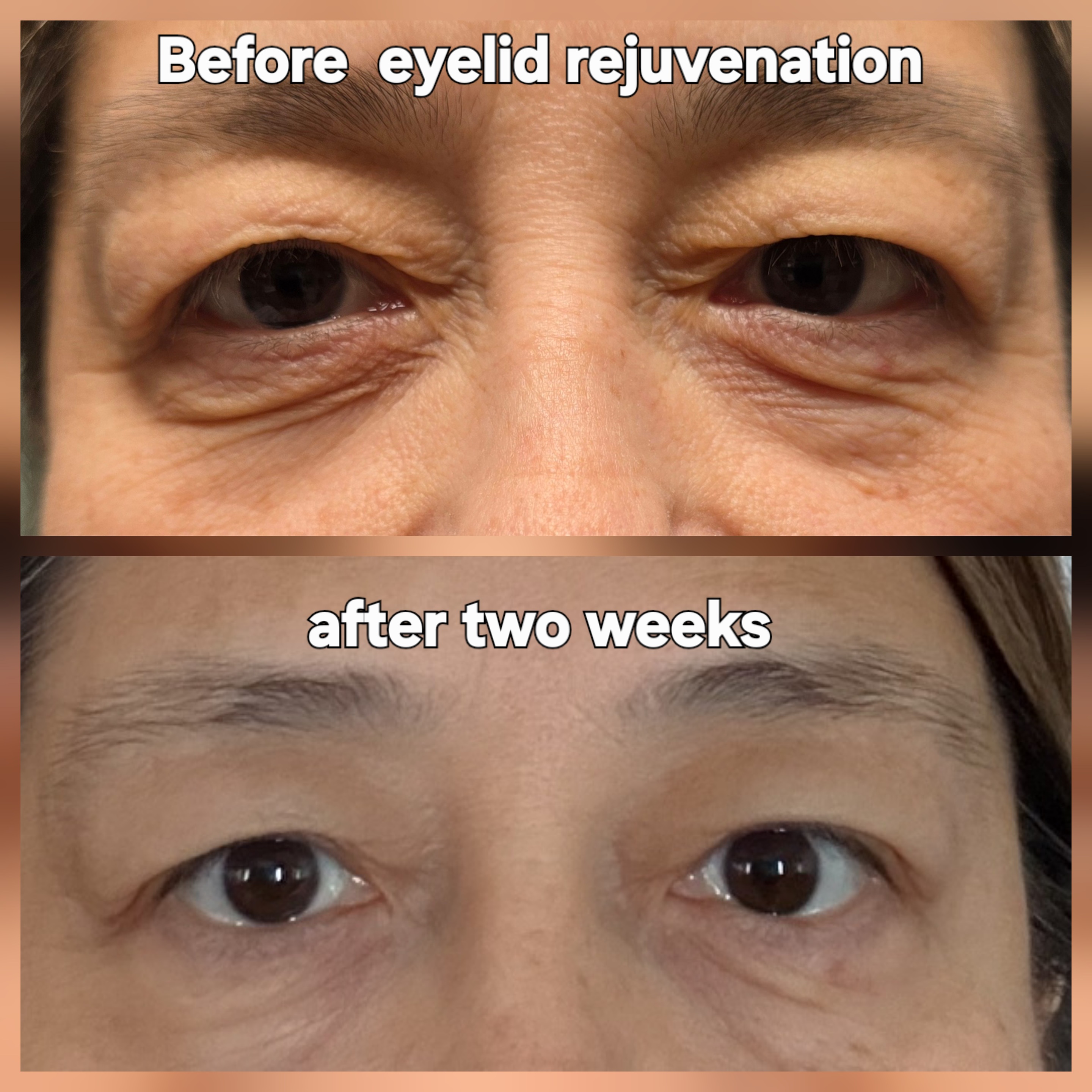 Eye lid tightened 