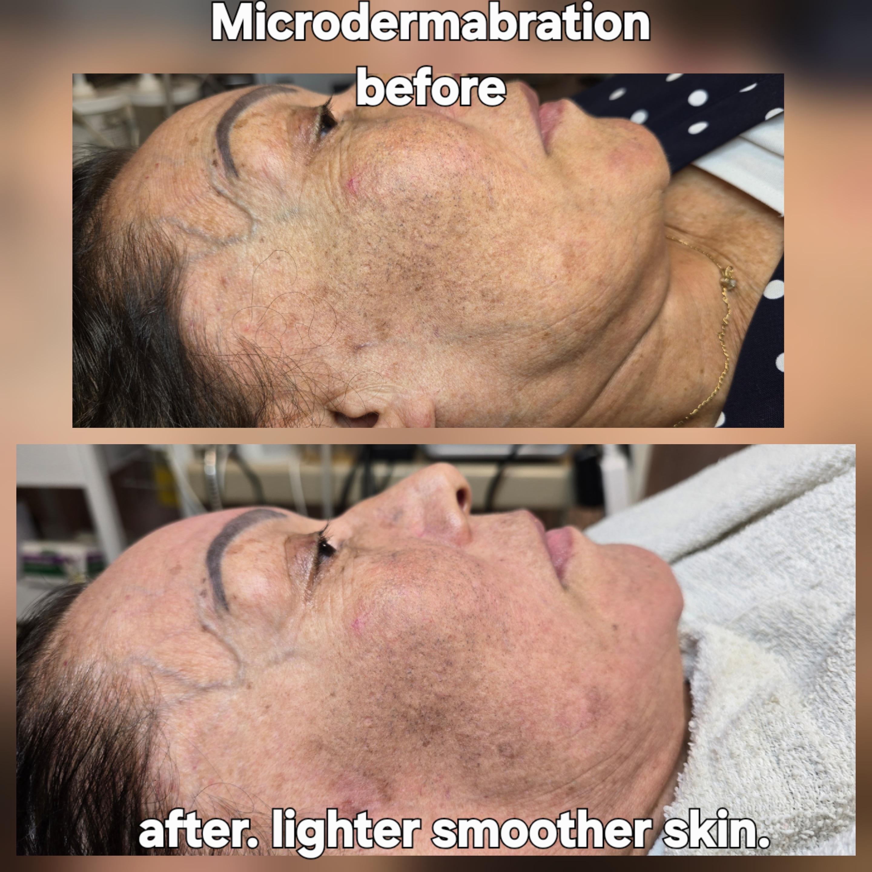 Facial rejuvenation 