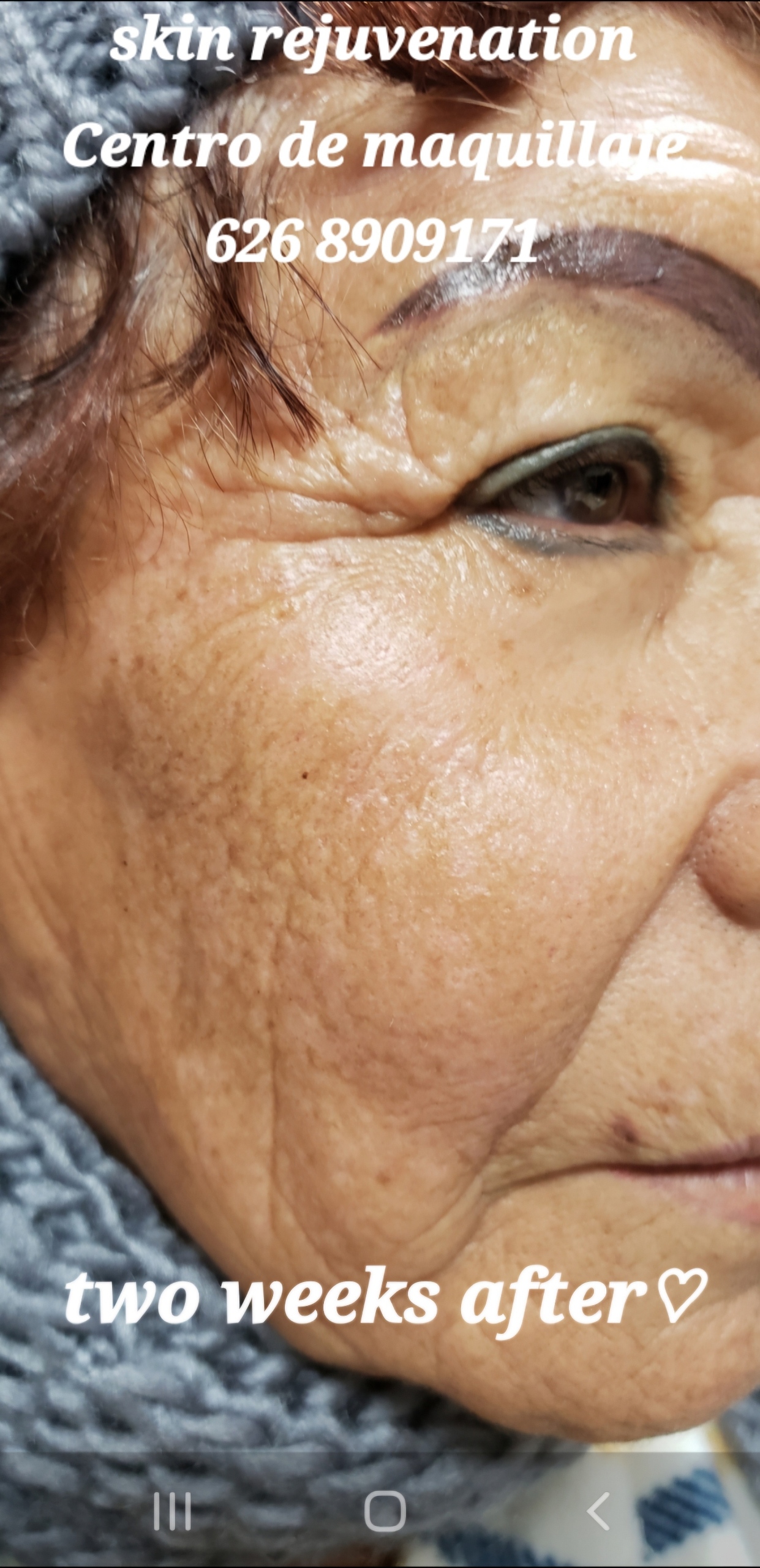Skin rejuvenation 